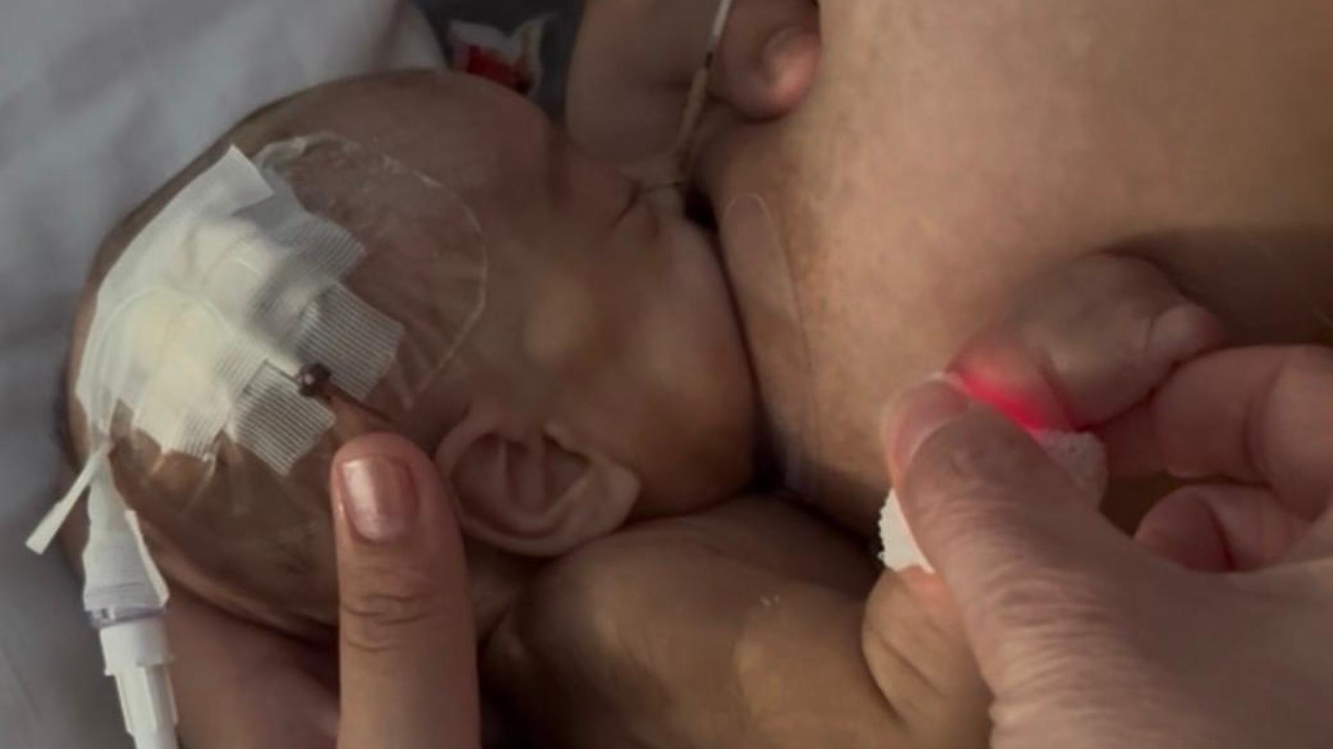 Duplicar la lactancia materna en neonatología es posible: el papel clave de la enfermería especializada